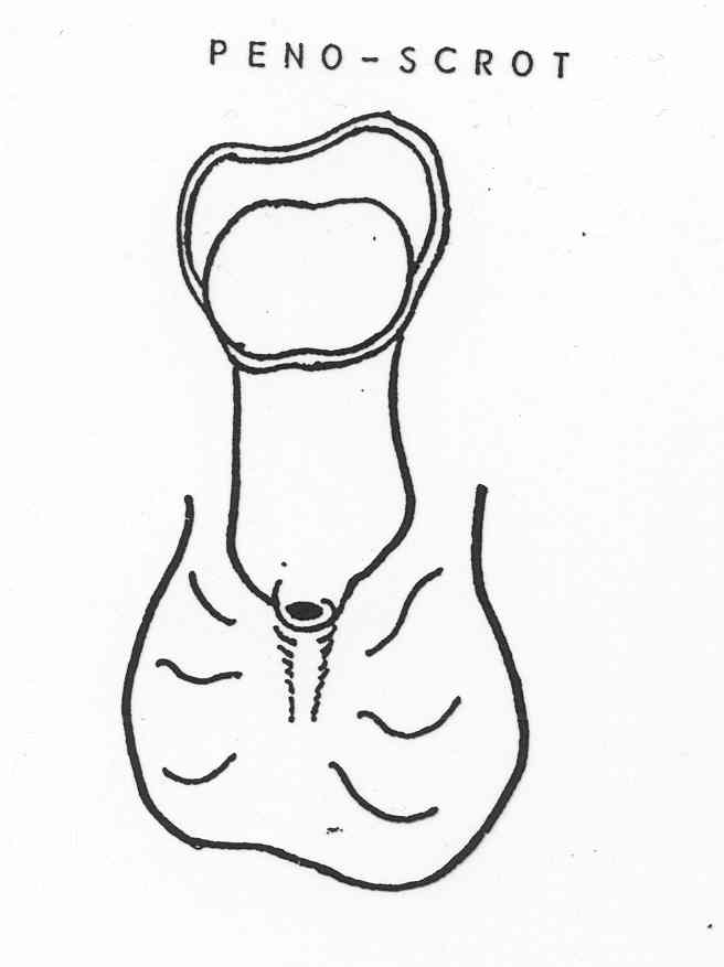 Ectopie testiculaire (et Cryptorchidie ) - Pediatric Surgery