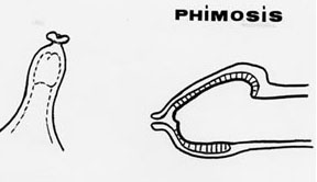 Phimosis, Paraphimosis et circoncision - Pediatric Surgery