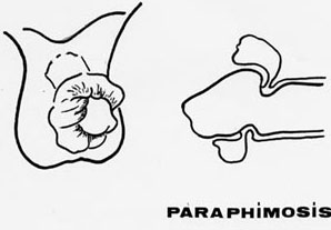Phimosis, Paraphimosis et circoncision - Pediatric Surgery