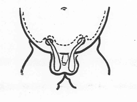 Ectopie testiculaire (et Cryptorchidie ) - Pediatric Surgery