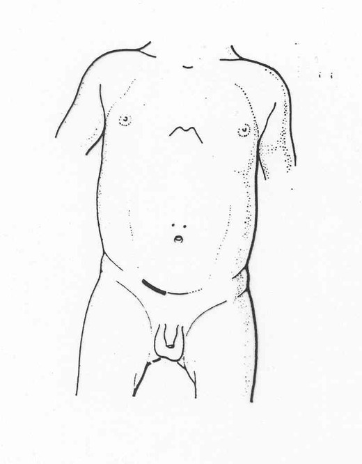 Ectopie testiculaire (et Cryptorchidie ) - Pediatric Surgery